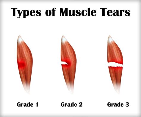 what test shows muscle tears|muscle strain vs tear imaging.